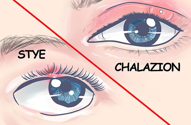 CHALAZION STYE