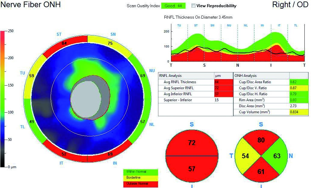 Imaging of the thickness of the retinal nerve fiber layer using Angiovue