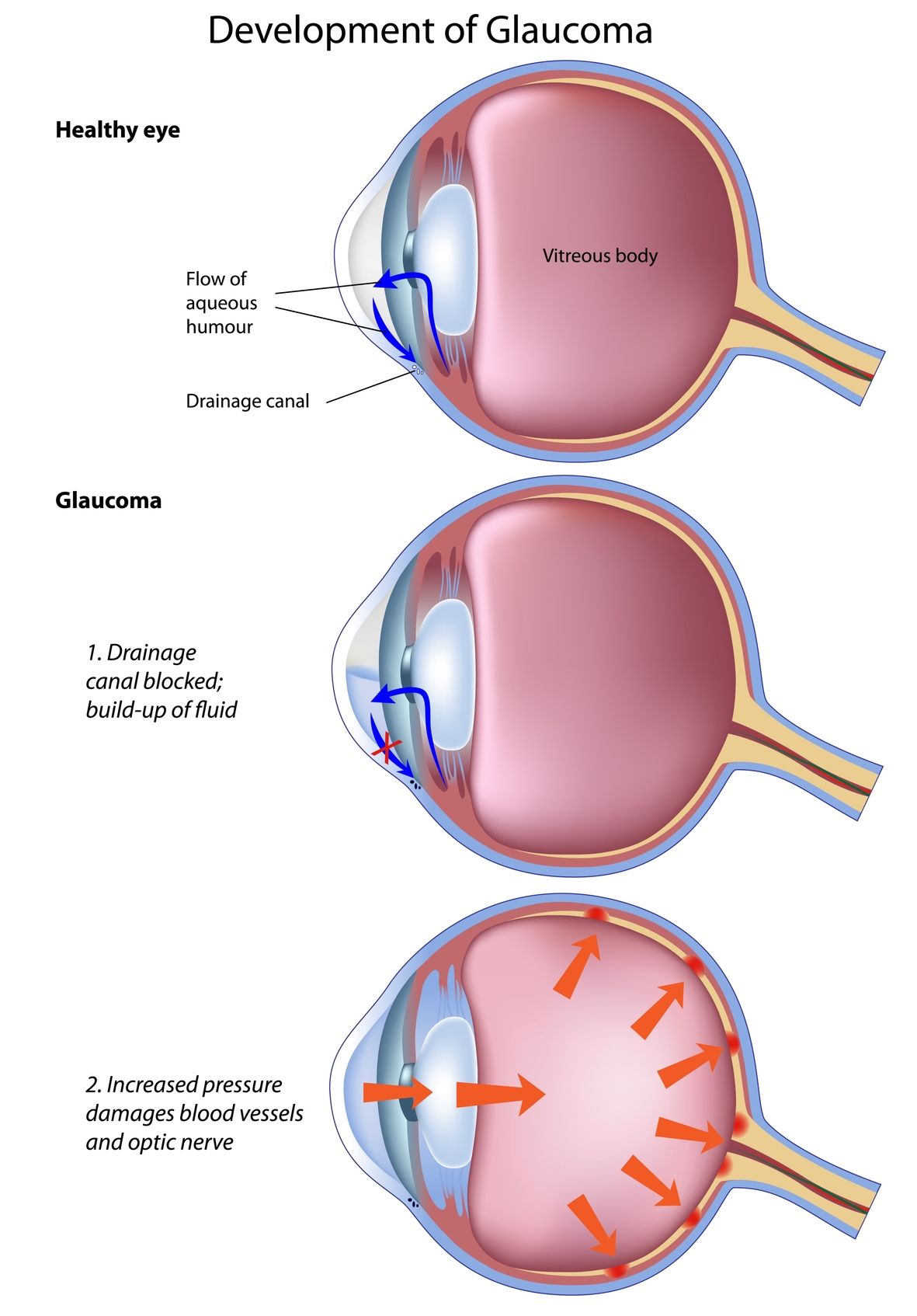 How is glaucoma created?