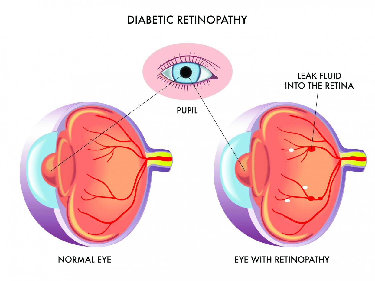 Diabetic Retinopathy