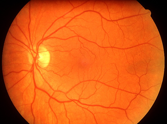 Optical Coherence Tomography