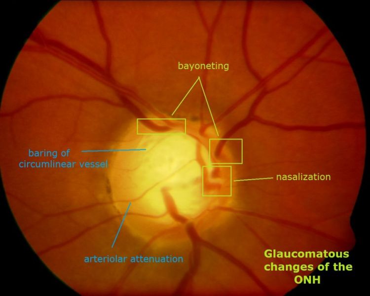 γλαύκωμα - εικόνα 3
