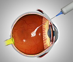 Intravitreal injections