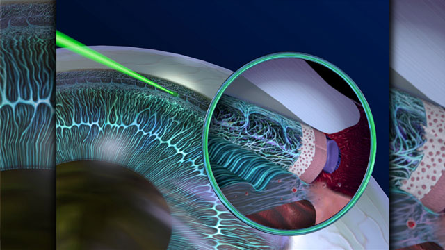 Laser for the treatment of glaucoma