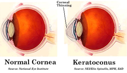 Keratoconus-normal-cornea