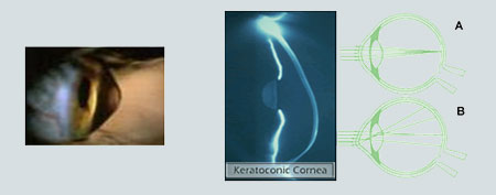 Keratoconus