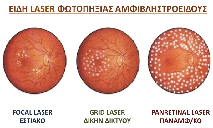 Photocoagulation Types