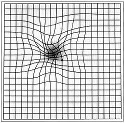 Patient with AMD in Amsler grid