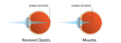 Μυωπία laser Μυωπίας