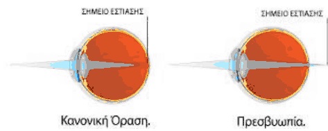 Presbyopia