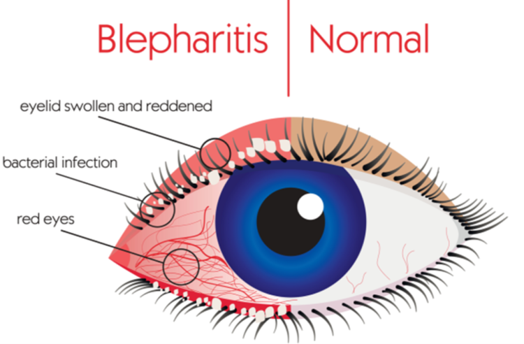 Βλεφαρίτιδα