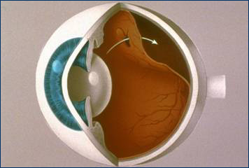 Image of retinal tear